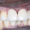 Crowns After